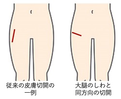 従来の皮膚切開の一例 太腿のしわと同方向の切開
