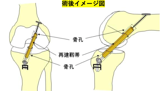 膝前十字靭帯再建術 股関節 人工関節センター 診療科案内 診療科 部門案内 静岡市の総合病院 静岡赤十字病院